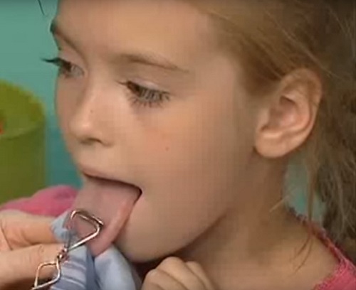 массаж при дизартрии у ребёнка